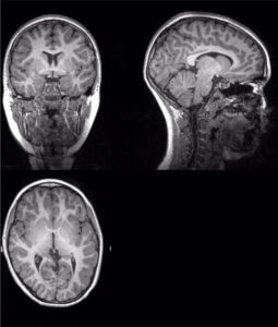 Ejemplo de imagen original de la resonancia magnética a partir de la cual investigadores de la UGR han extraído la cantidad total de materia gris, materia blanca, y cantidad total cerebral. / Foto: UGR / Europa Press.