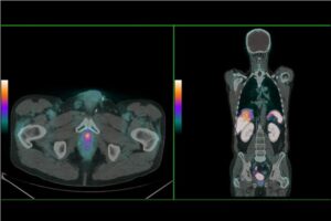 Premio nacional a un trabajo malagueño para la detección de cáncer de próstata