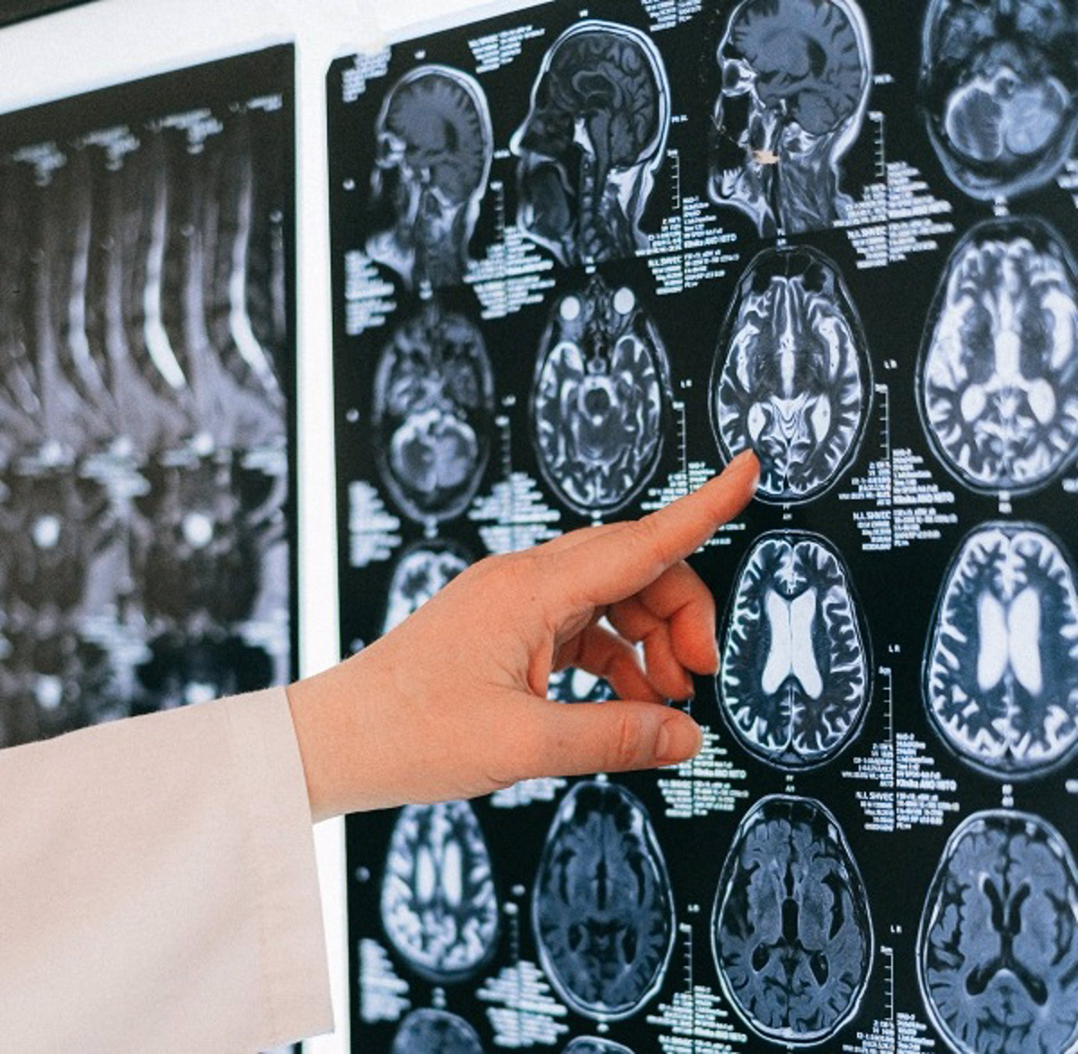 Logran en Córdoba una herramienta para diagnosticar el grado de afección del Parkinson